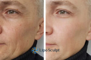 Fight Aging Symptoms Malvern Common With HIFU and Morpheus8 Today!