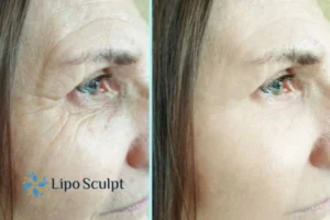 Do you want to Fight Aging Symptoms Malvern Common? Contact Lipo Sculpt today!