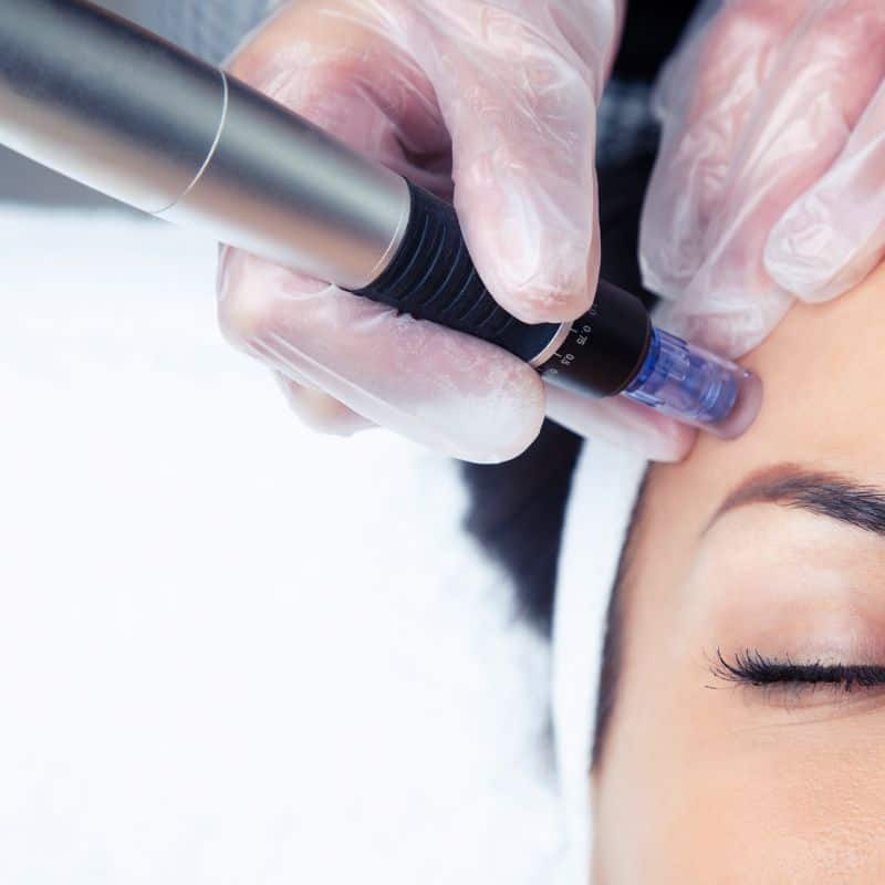 Morpheus8 treatment Malvern Common from Lipo Sculpt - Book in today!