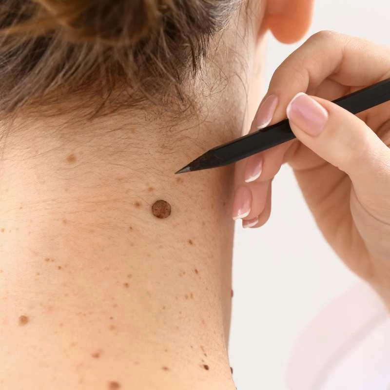 See our lesion removal prices Malvern Common - call today for a free quote